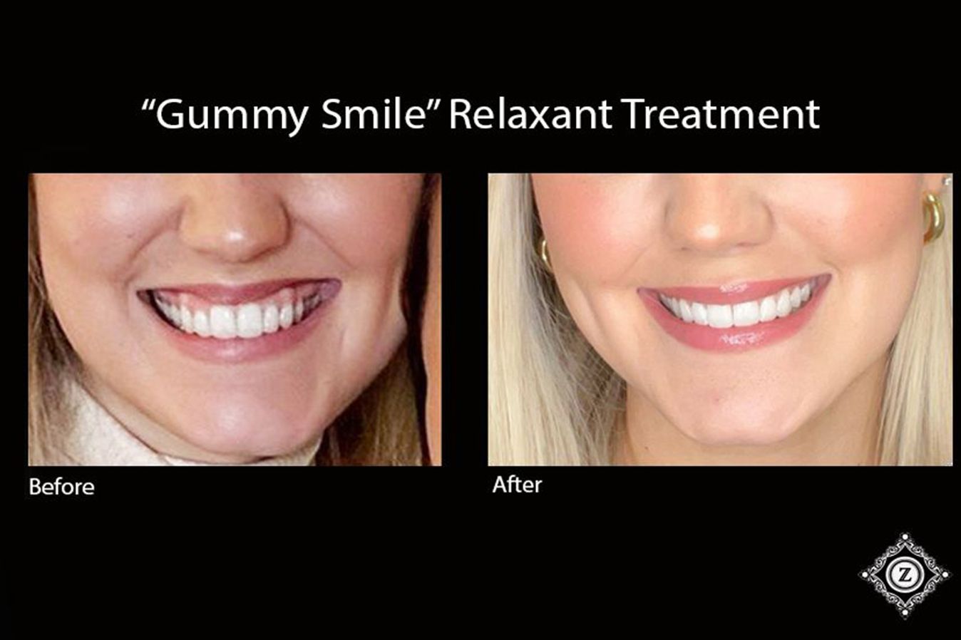 Before & After Photo of Botox Patient at Z Dermatology in Baton Rouge, Louisiana