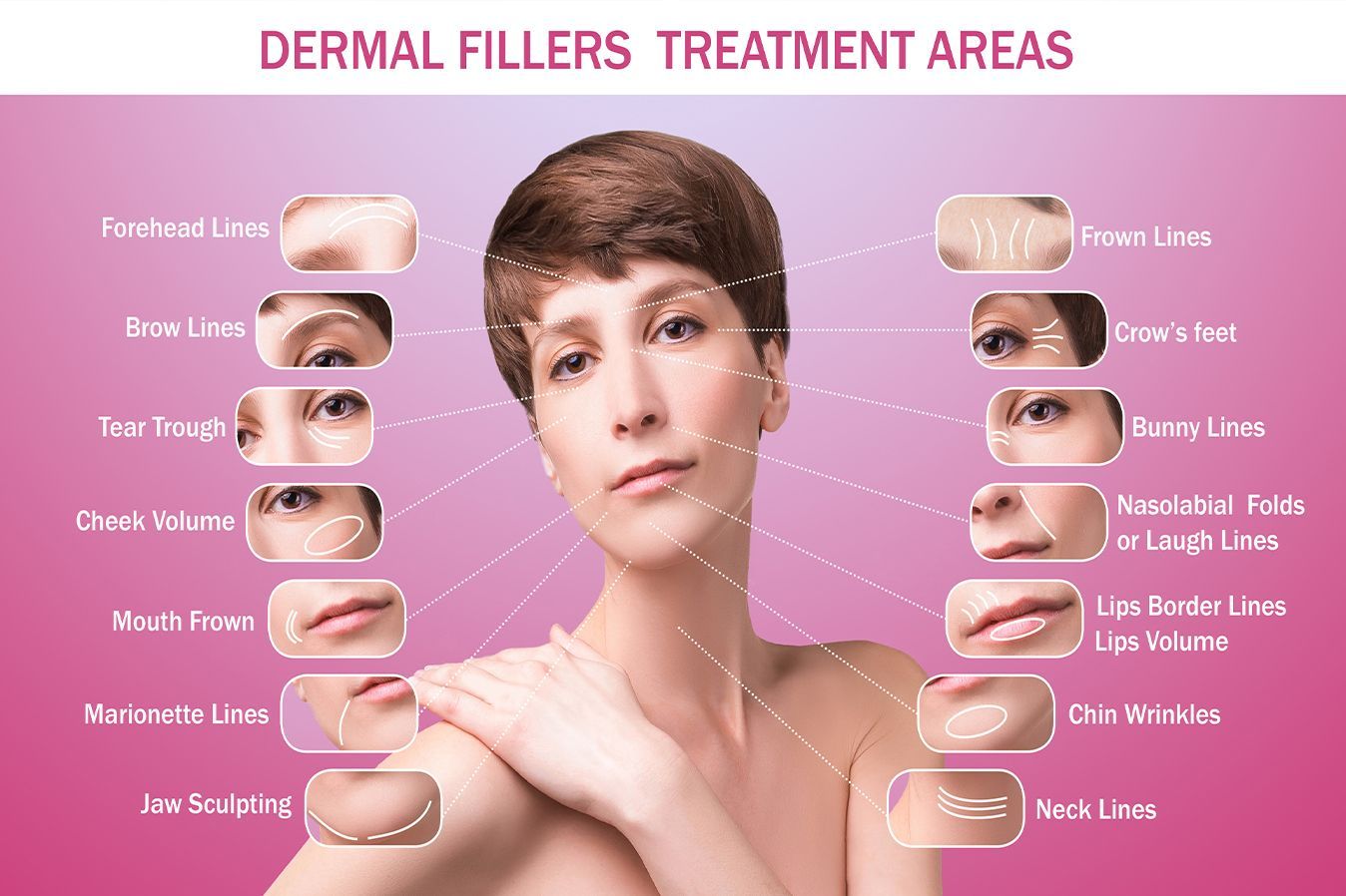 Dermal Fillers Treatment Areas shown on a model for Z Aesthetic Dermatology in Baton Rouge.