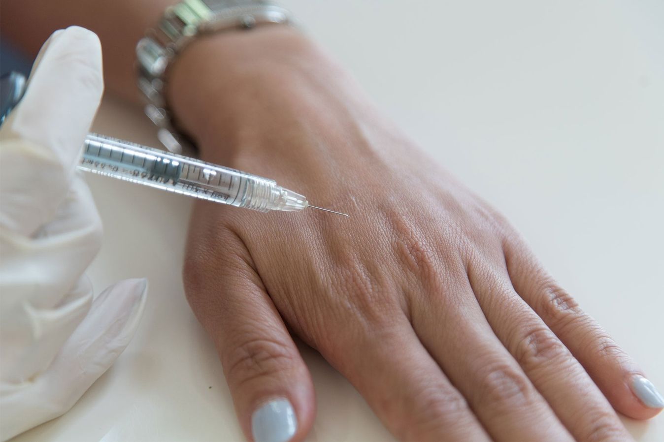 Radiesse Filler for Hands in Baton Rouge & Prairieville