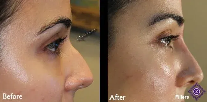 Dermal filler cheekbones before and after, Dr. Z