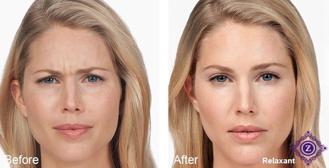 Botox Baton Rouge before and after 11s treatment, natural results