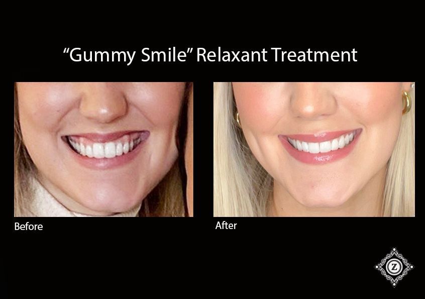 Botox Baton Rouge Before and After for Gummy Smile at Z Aesthetic Dermatology