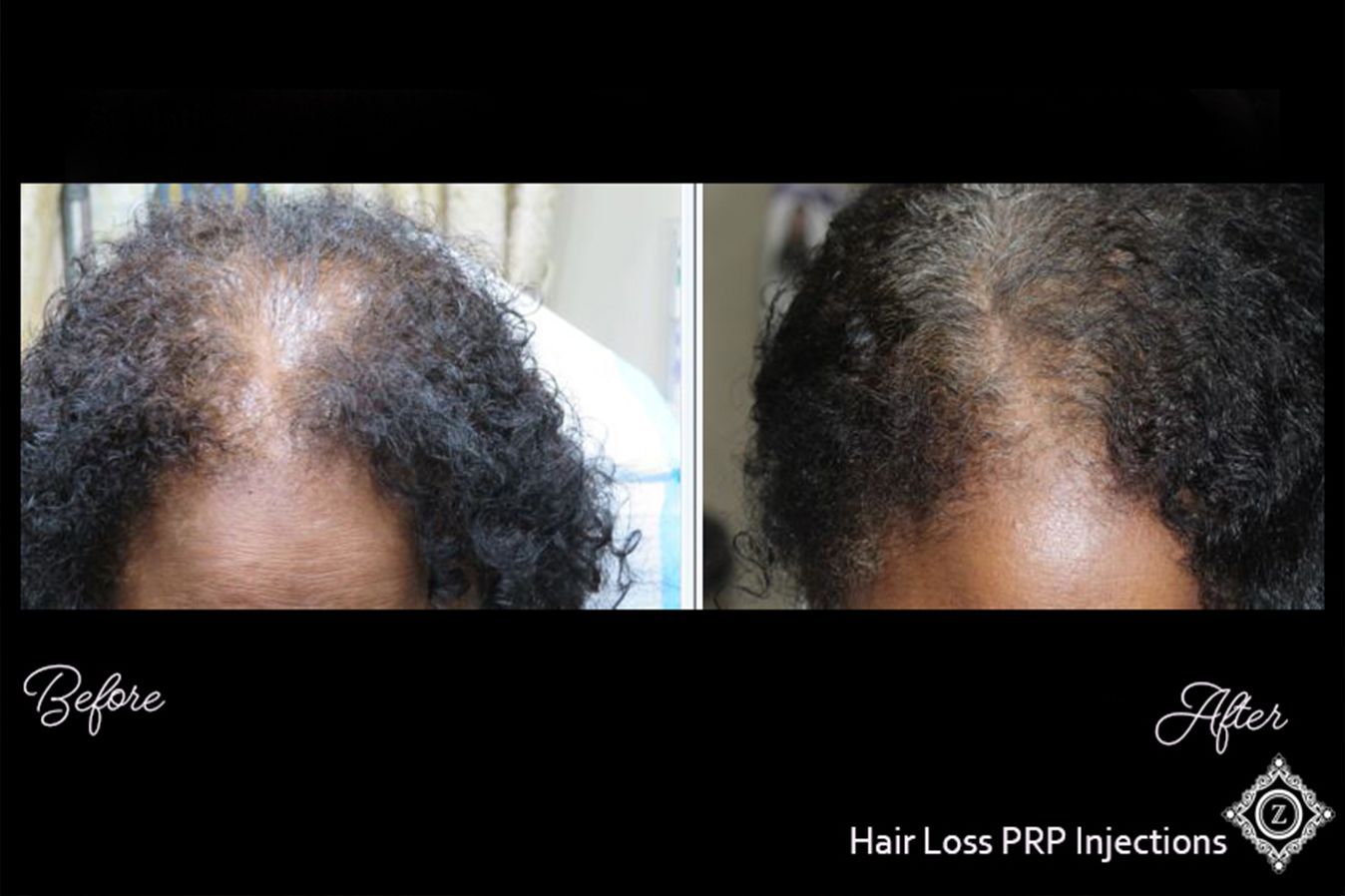 Hair Restoration Before & After Treatment in Baton Rouge at Z Aesthetic Dermatology