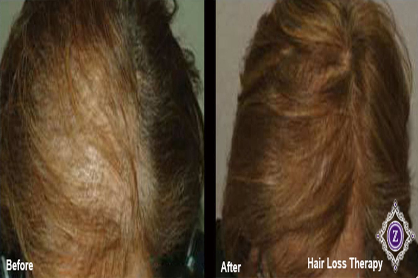 Hair Restoration Before & After Treatment in Baton Rouge at Z Aesthetic Dermatology