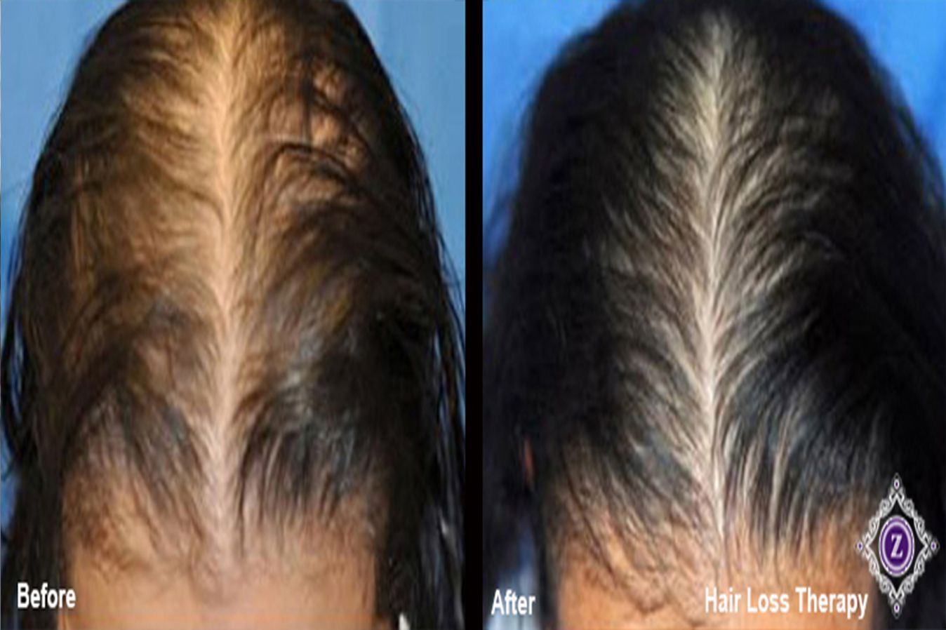Hair Restoration Before & After Treatment in Baton Rouge at Z Aesthetic Dermatology
