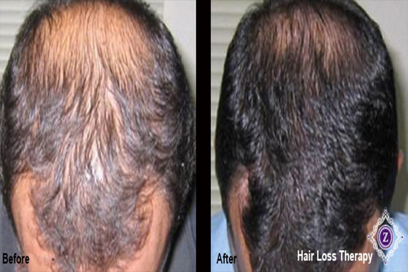 Hair Restoration Treatment Baton Rouge Before and After at Z dermatology