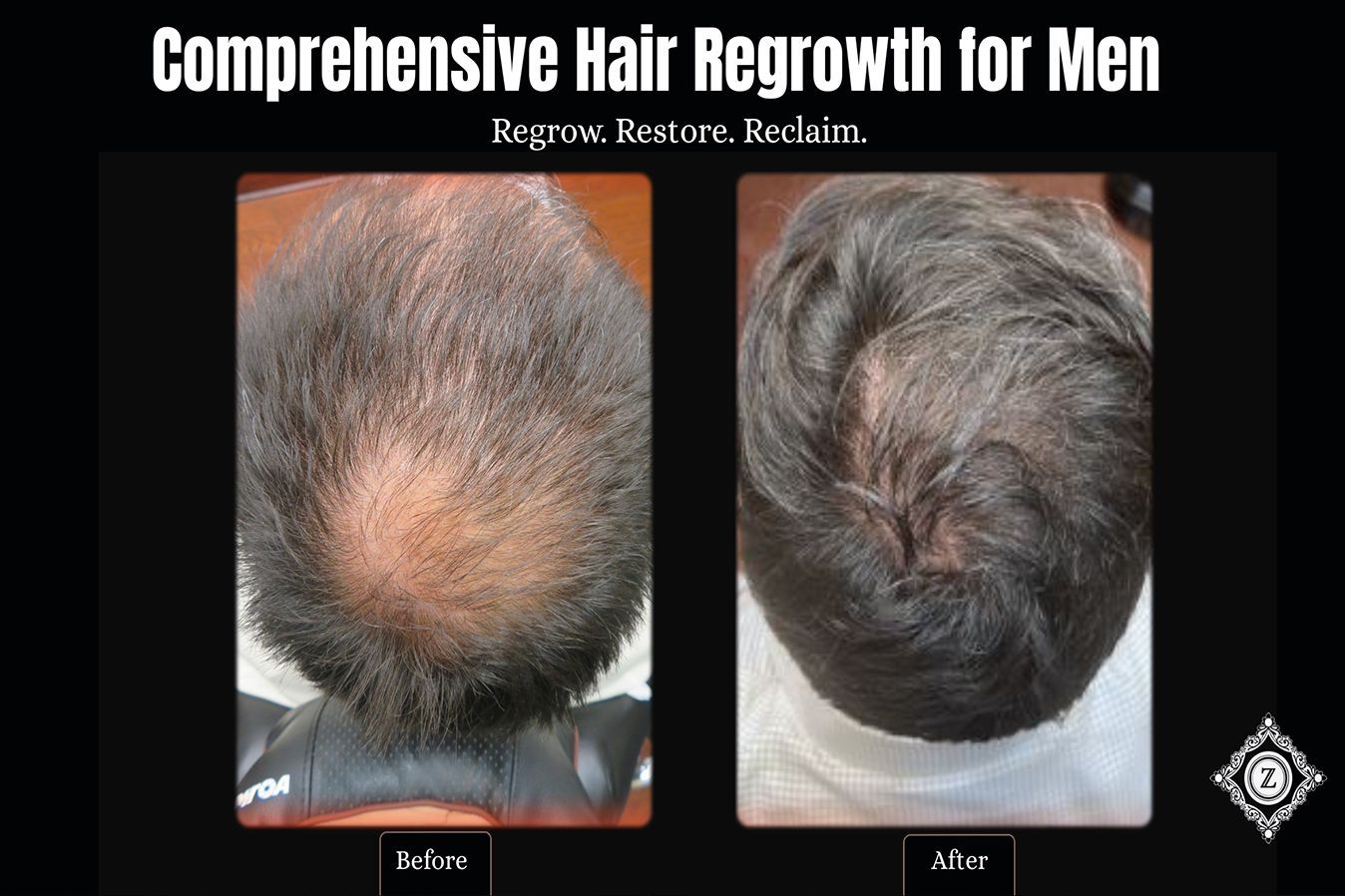 Hair Restoration Before & After Treatment in Baton Rouge at Z Aesthetic Dermatology