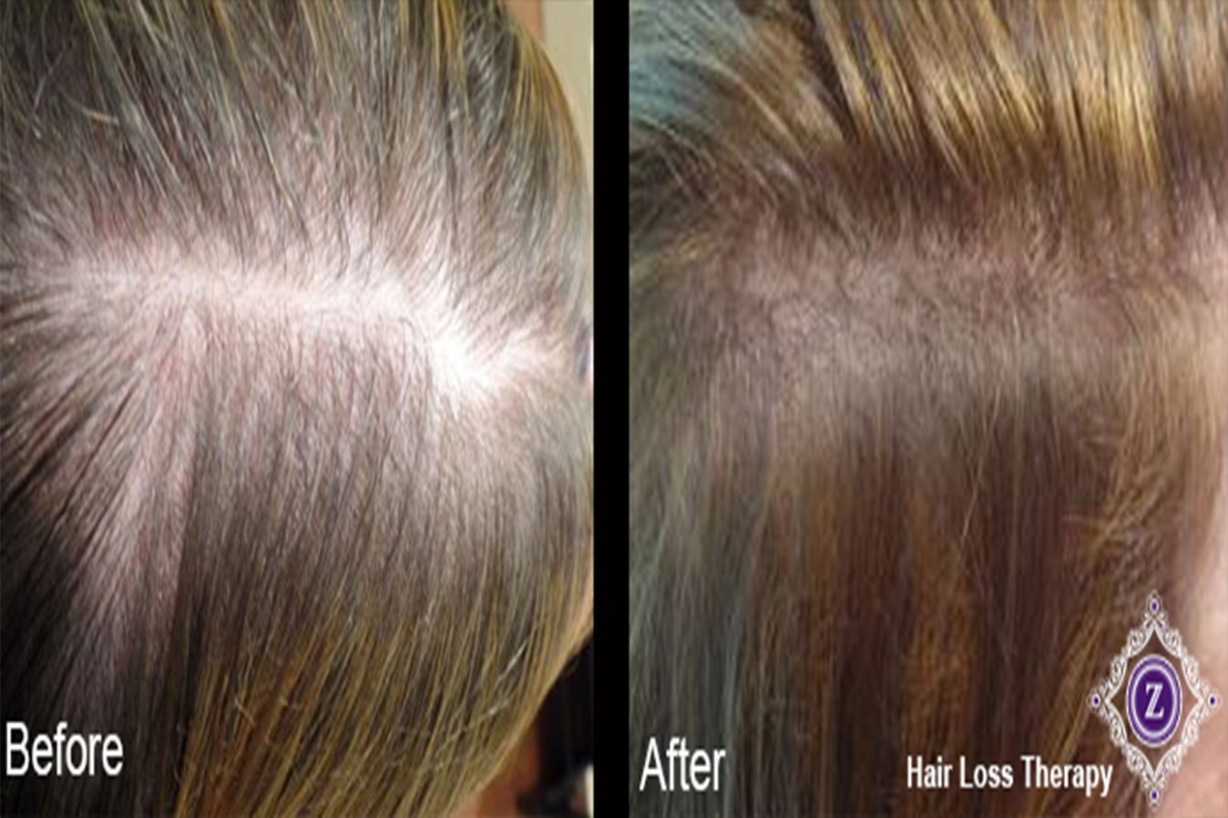 Hair Restoration Treatment Baton Rouge Before and After at Z dermatology