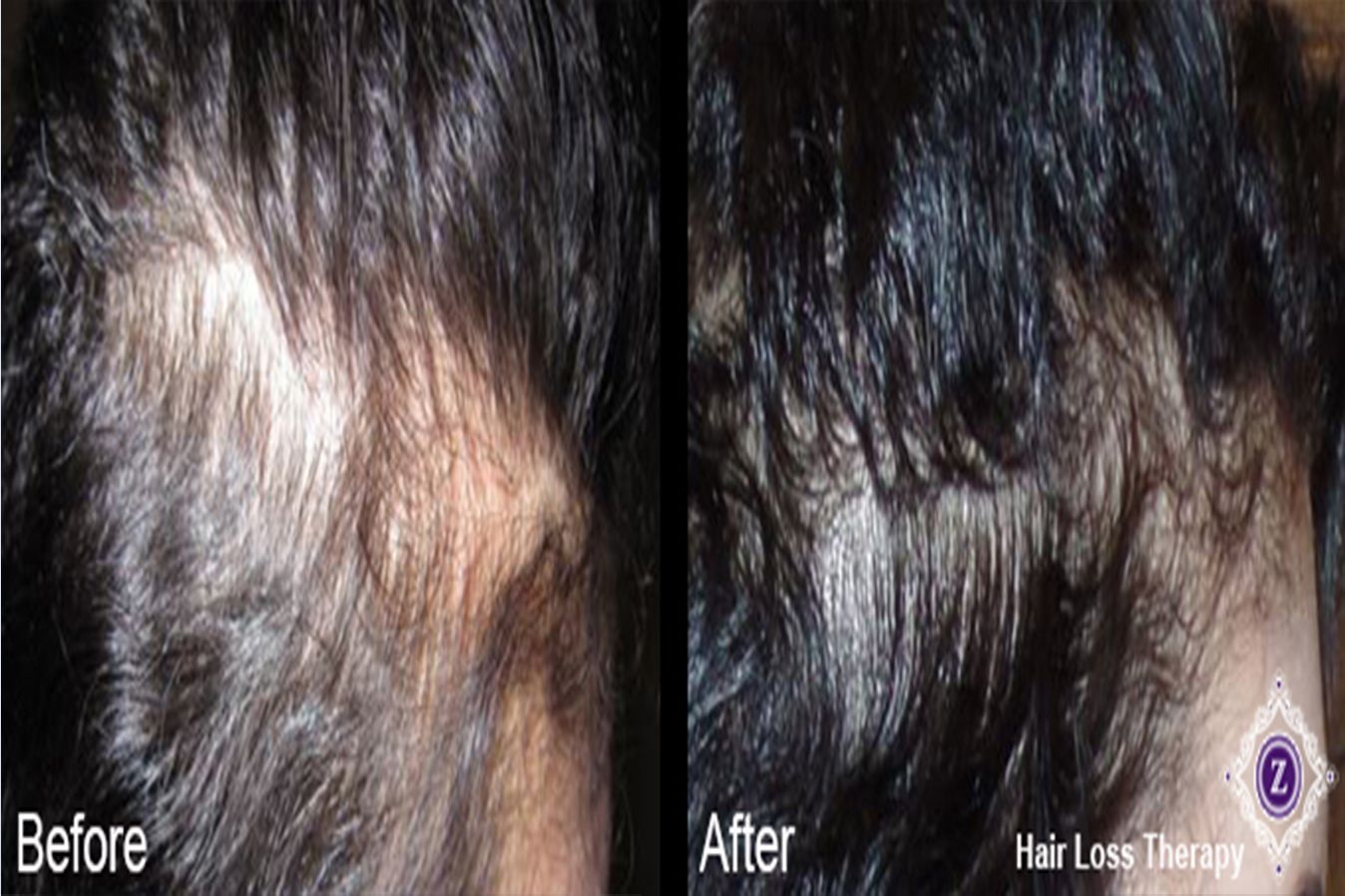 Hair Restoration Treatment Baton Rouge Before and After at Z dermatology