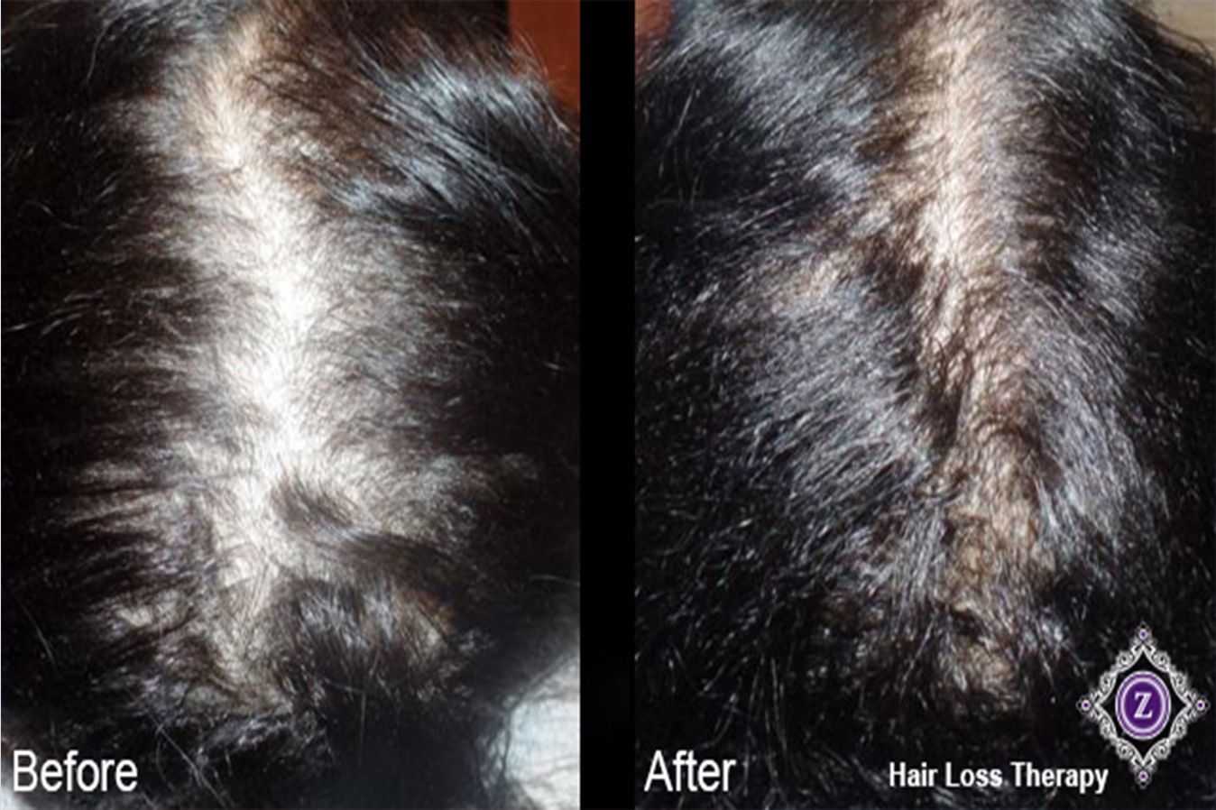 Hair Restoration Treatment Baton Rouge Before and After at Z dermatology