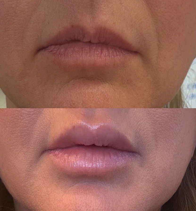Lip enhancement results Dr. Z Baton Rouge
