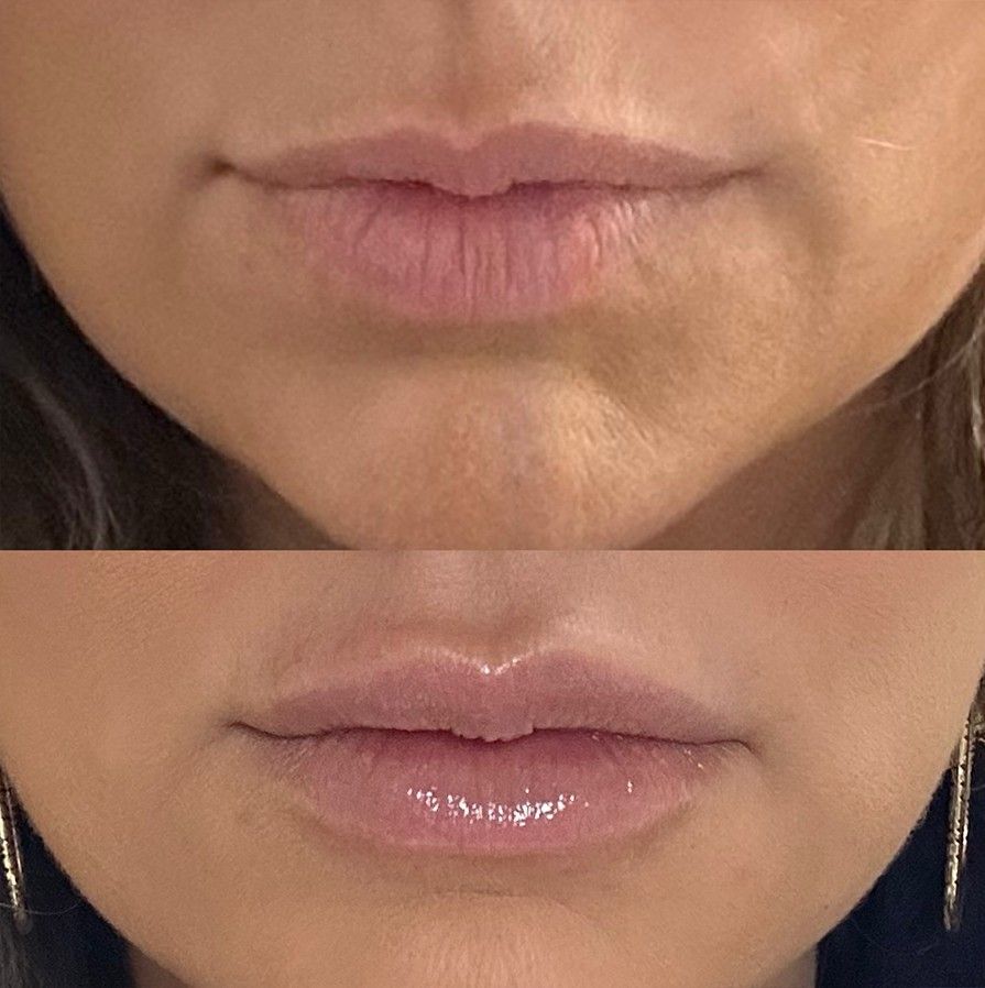 Lip enhancement results Dr. Z Baton Rouge