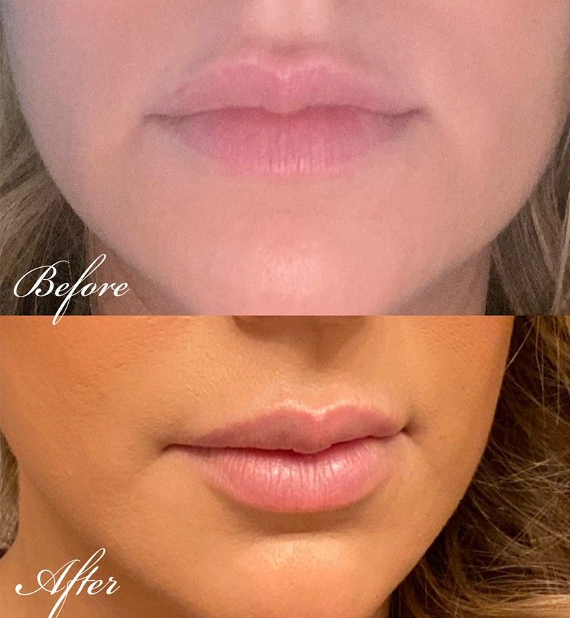 Lip enhancement results Dr. Z Baton Rouge