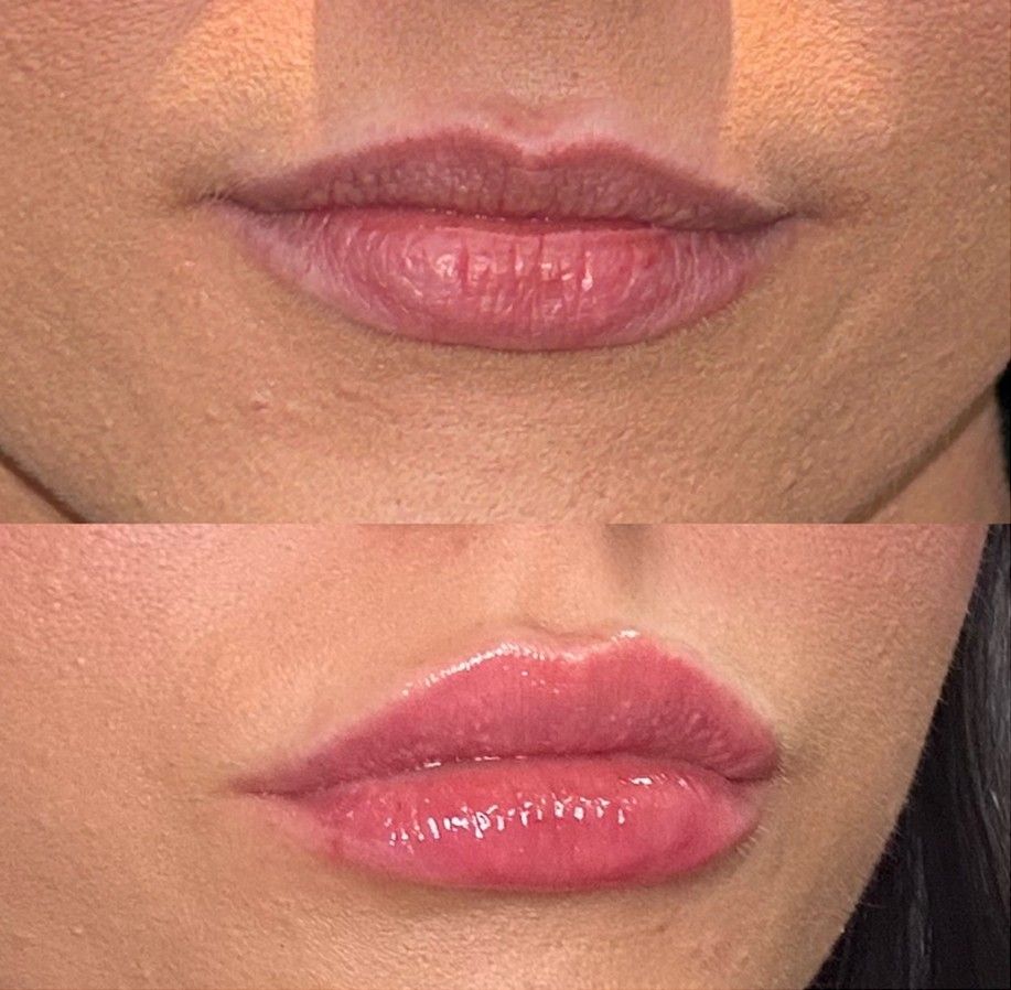 Lip filler before and after, natural fuller lips