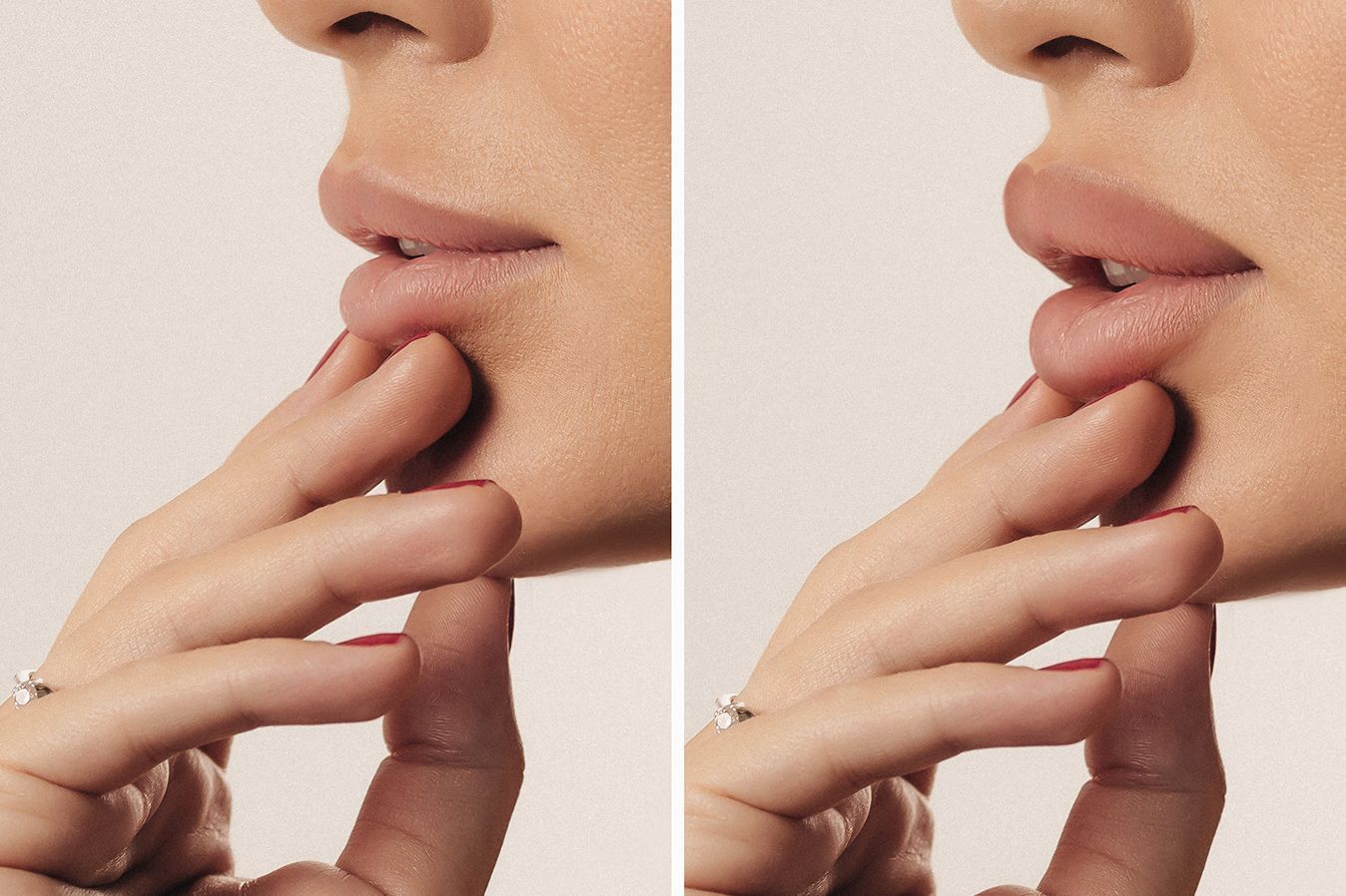 Lip Filler Treatment in Baton Rouge & Prairieville