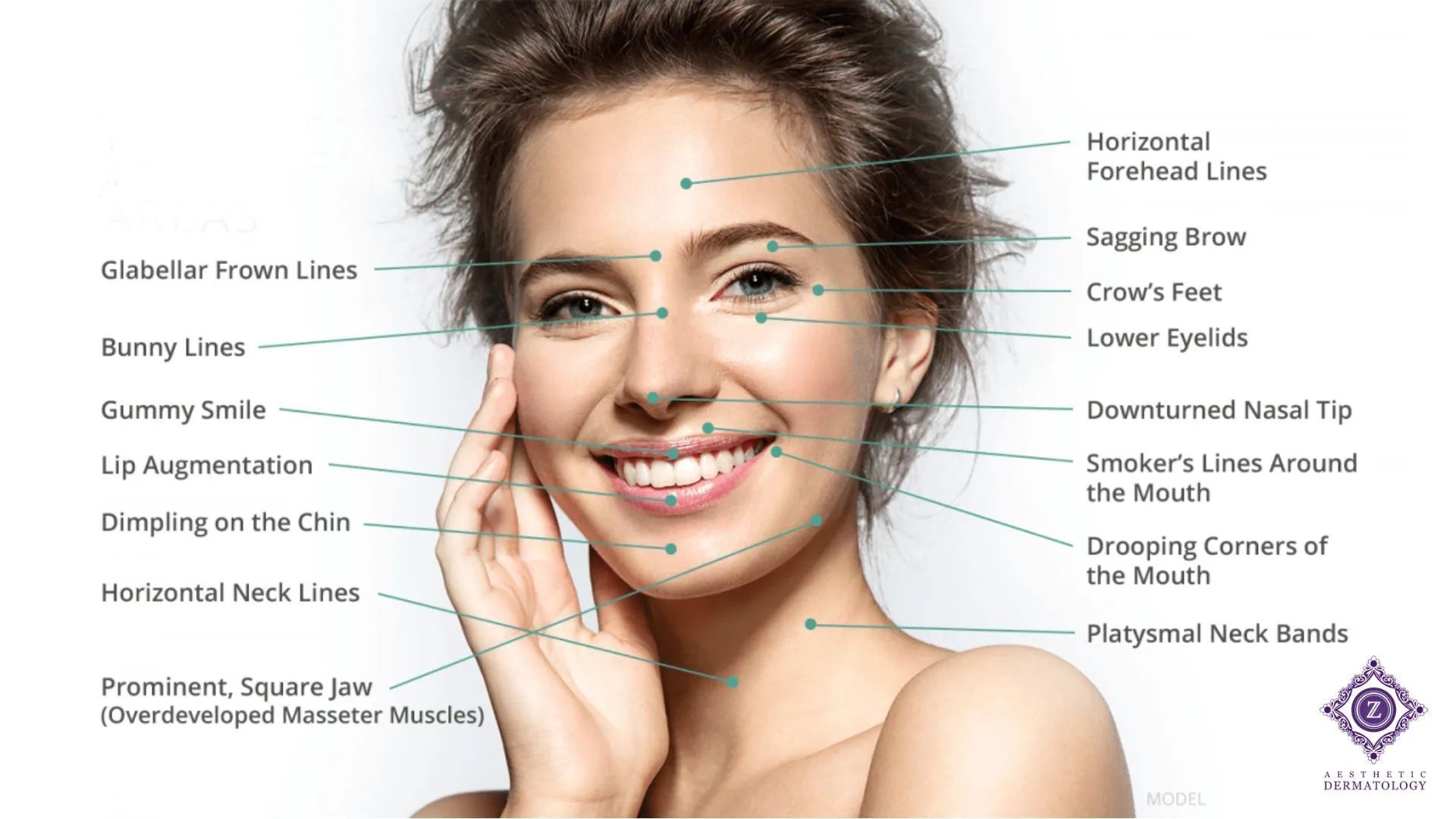 Botox and Neuromodulator Treatment Areas shown on a model for Z Aesthetic Dermatology in Baton Rouge.