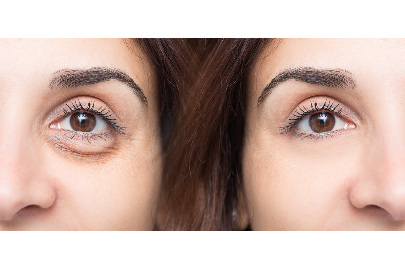 PRP under eye injections before and after, Dr. Z