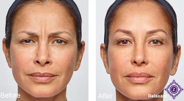 Botox forehead lines before and after, Dr. Z, Baton Rouge