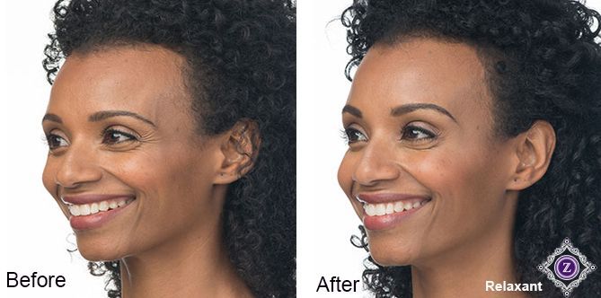 Botox Baton Rouge crows feet treatment before and after, Dr. Z, Baton Rouge