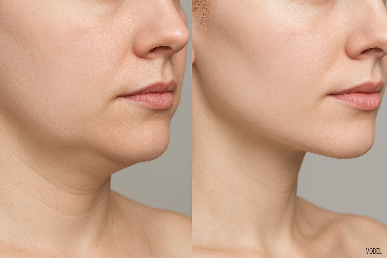 TMJ Masseter Botox Injections in Baton Rouge, LA at Z Dermatology.