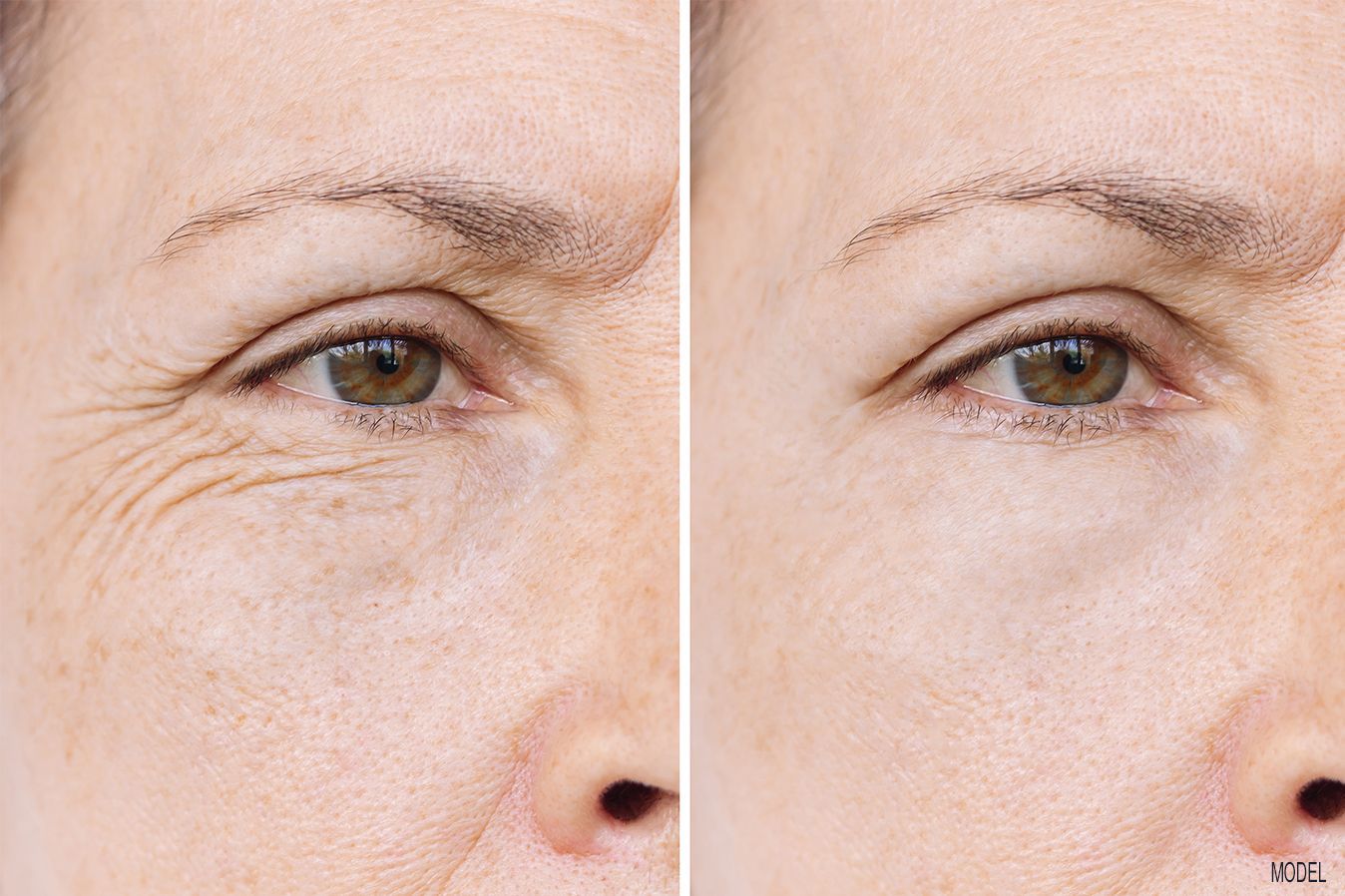 Wrinkle treatment before and after, Botox and fillers Baton Rouge, Dr. Z