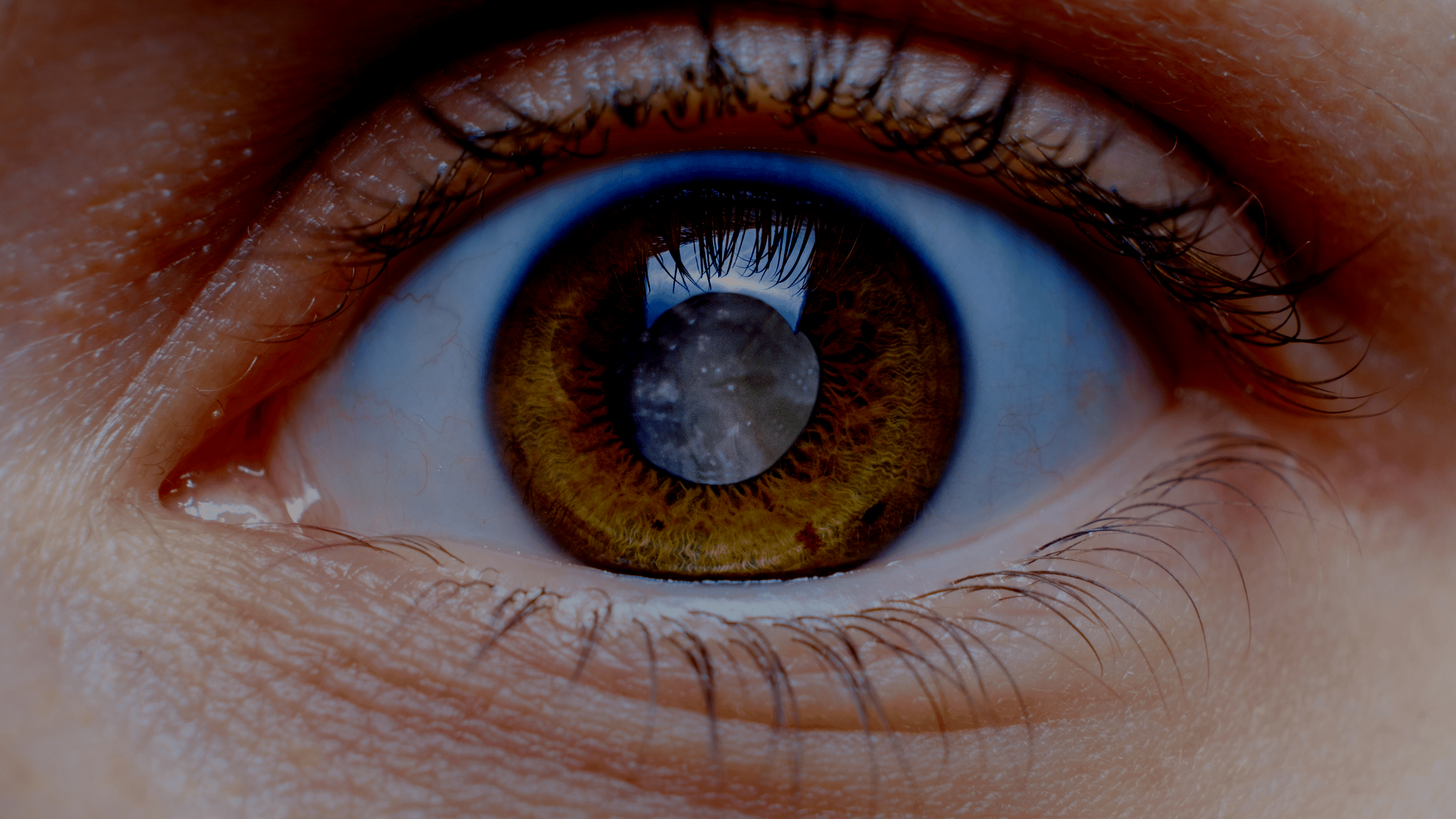 patient story of living with cataracts