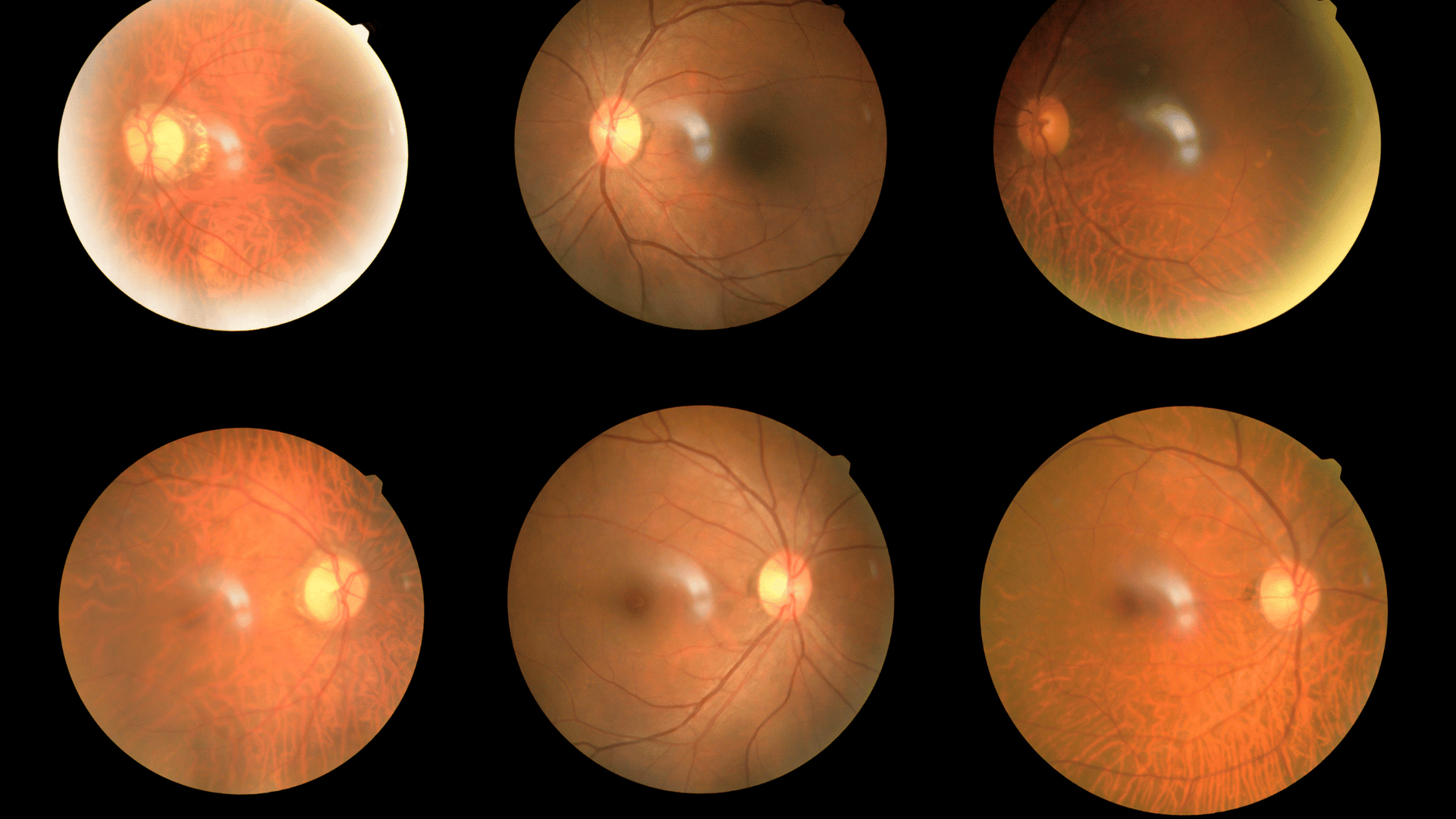 diabetic retinopathy blog pic