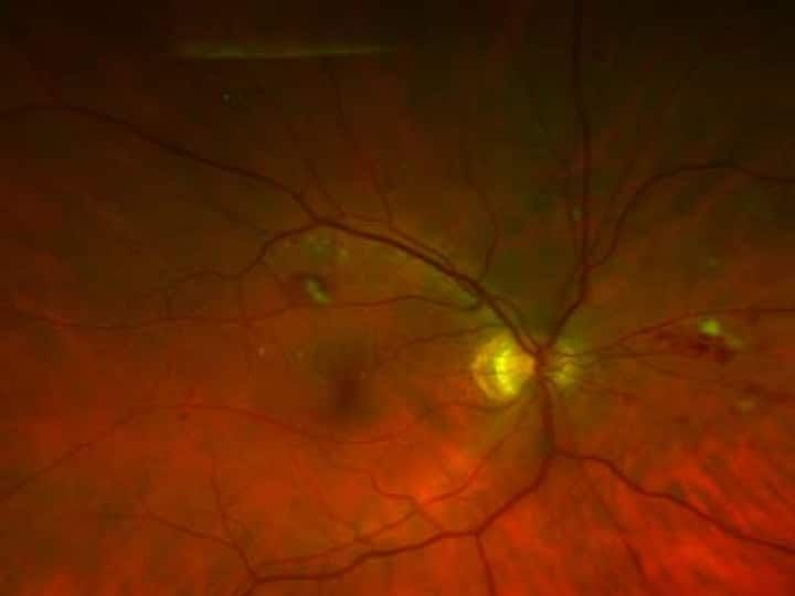 Diabetic changes seen on retina using Optos imaging