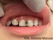 A close up of a person 's mouth with a hole in it.