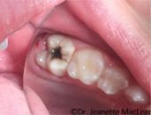 A close up of a person 's teeth with a hole in them.