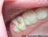 A close up of a person 's teeth in their mouth.