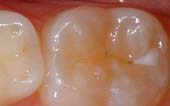 A close up of a tooth with a hole in it.