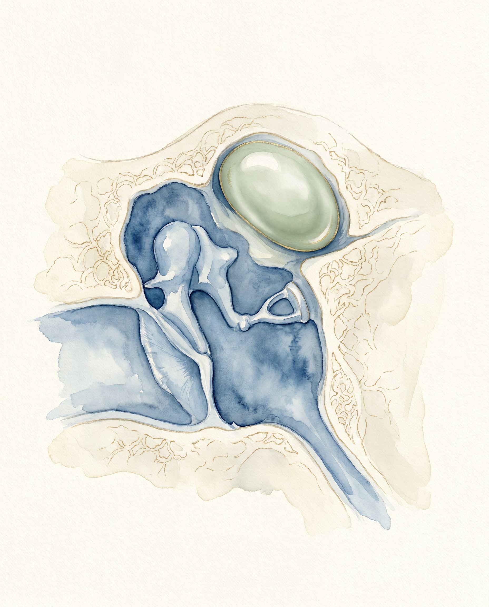 Colesteatoma — ilustración acuarela del oído medio con masa nacarada en el ático