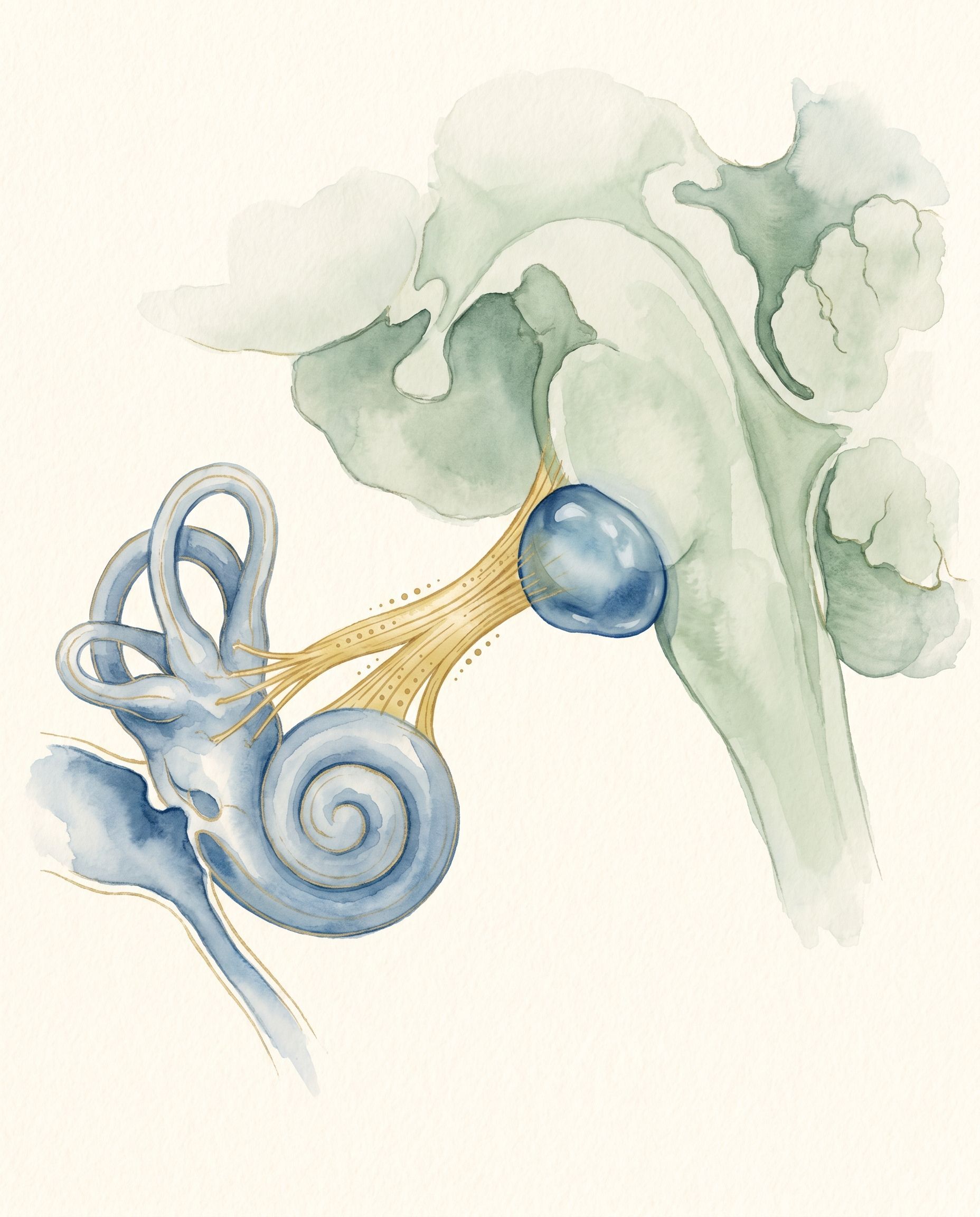 Neurinoma acústico — ilustración acuarela del schwannoma vestibular en el ángulo pontocerebeloso