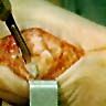 A medical surgical procedure shows a scalpel making an incision in skin held open by a metal retractor.