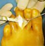A medical procedure on a foot where a metal instrument is held near the base of the toes on skin prepped with yellow iodine.