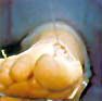 A close-up view of a human foot with a small, clear needle or thread entering the skin near the top of the toe area.