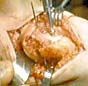 A surgical procedure in progress, showing gloved hands using instruments on exposed tissue during an operation.