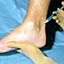 A medical professional administers an injection into the patient's ankle area.