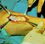 Surgical view of an incision held open by retractors on a patient’s skin, with sterile surgical drapes visible.