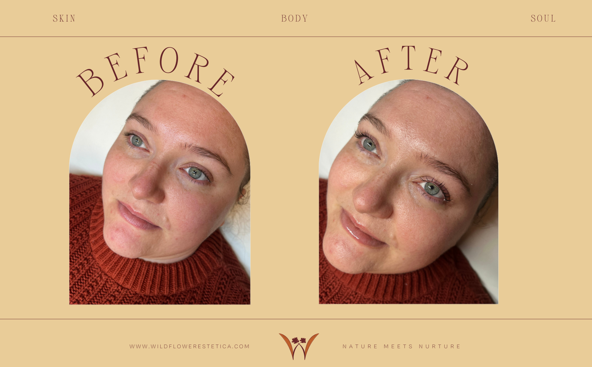 Side-by-side comparison of a person's face. Before shows dull skin; after shows hydrated skin with a glow.