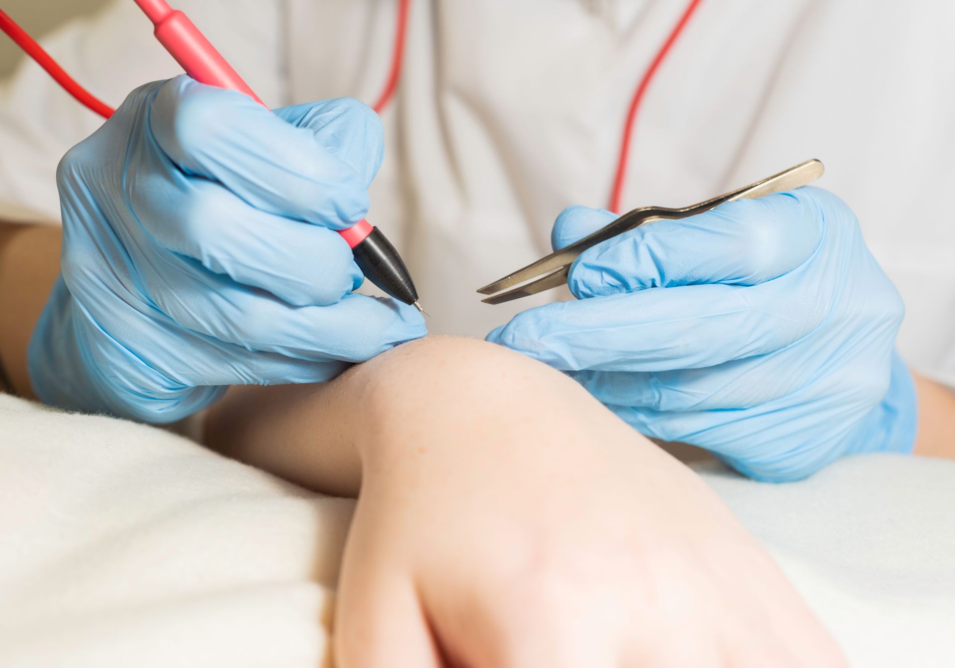 Gloved hands using a penlight and tweezers for an electrolysis treatment