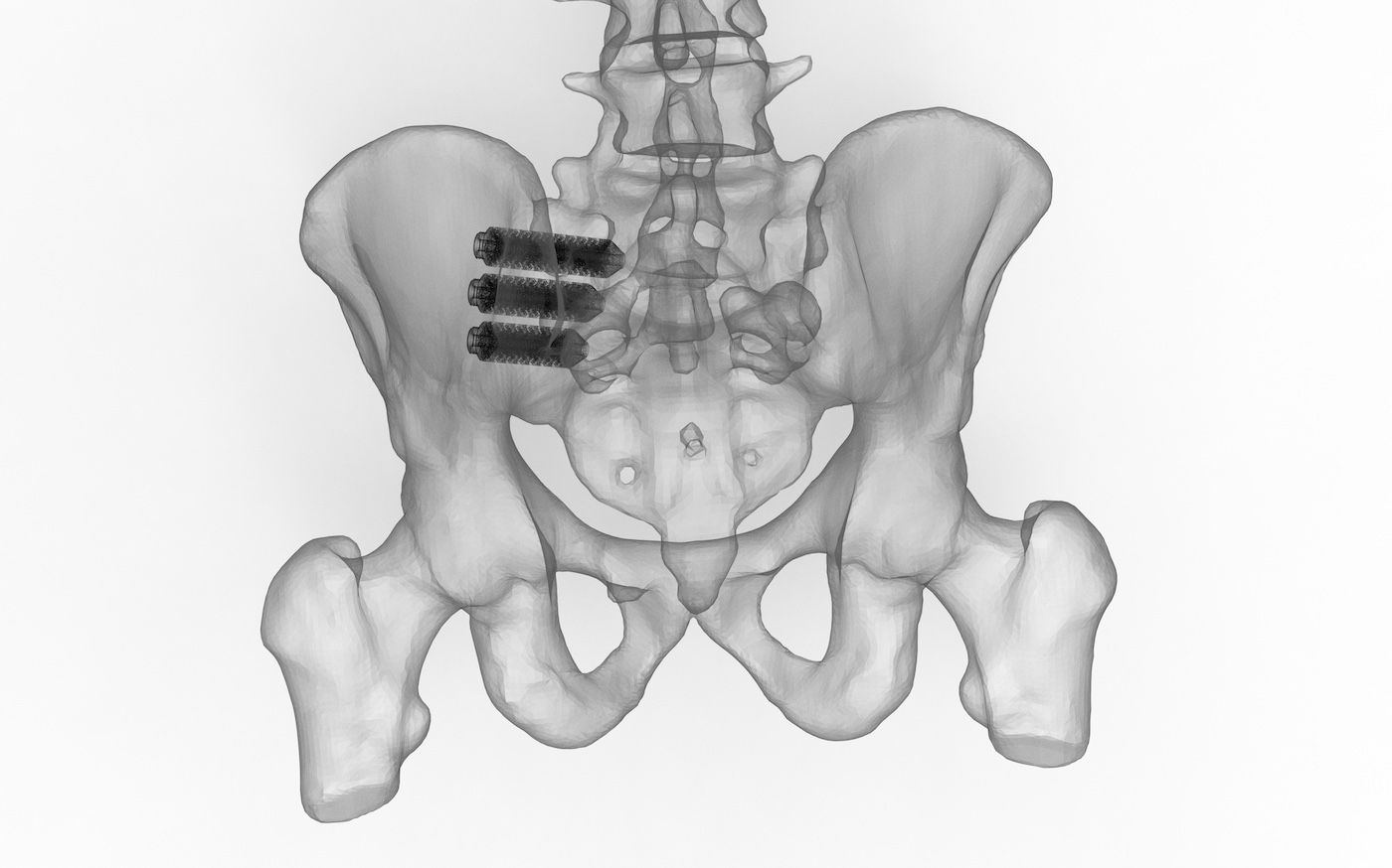 Minimally-Invasive Solutions for SI Joint Pain & Dysfunction