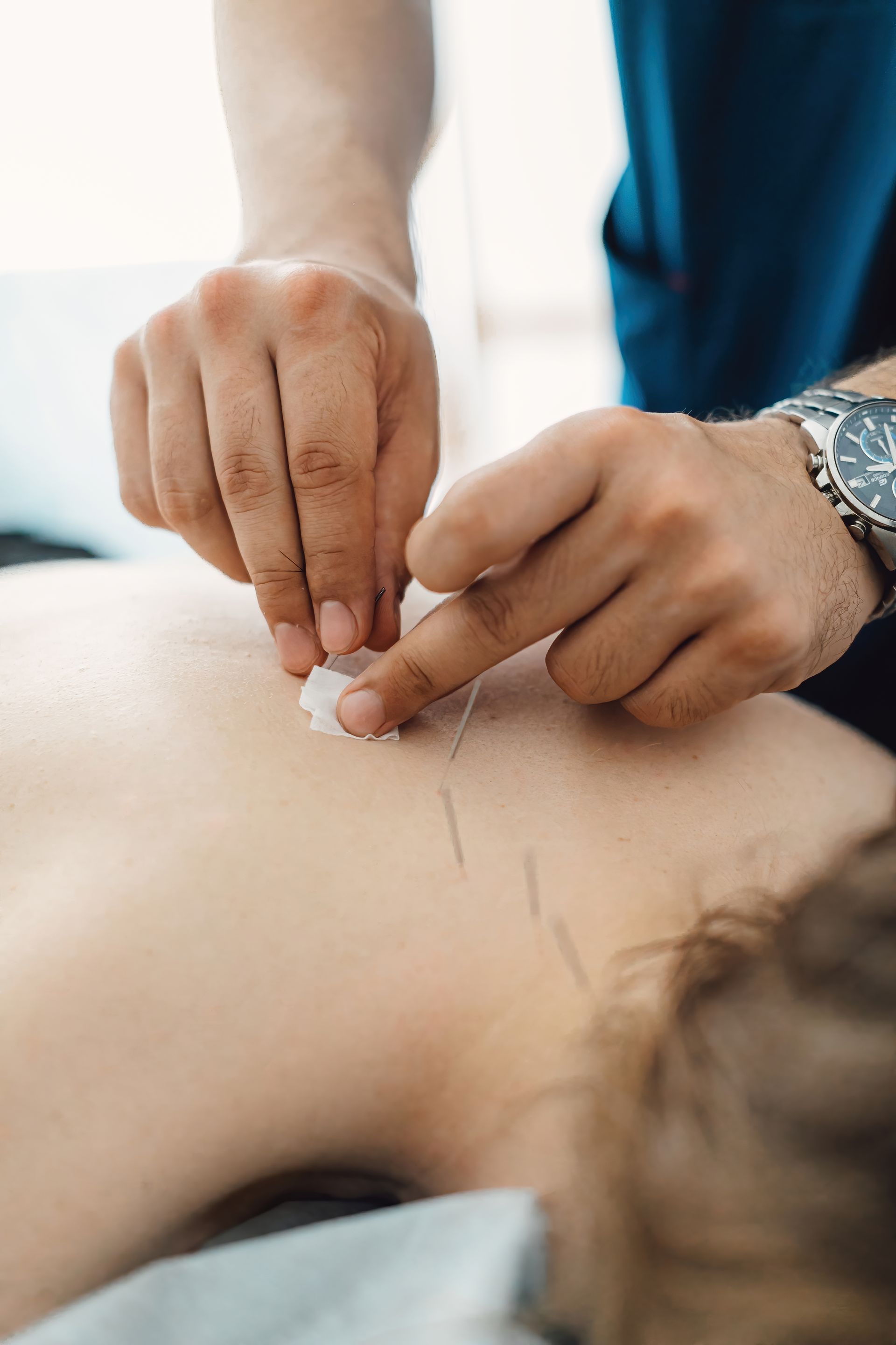 woman getting acupuncture
