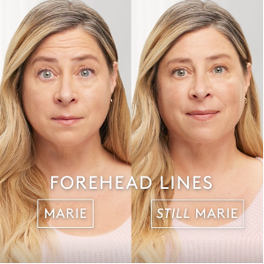 A before and after photo of a woman 's forehead lines