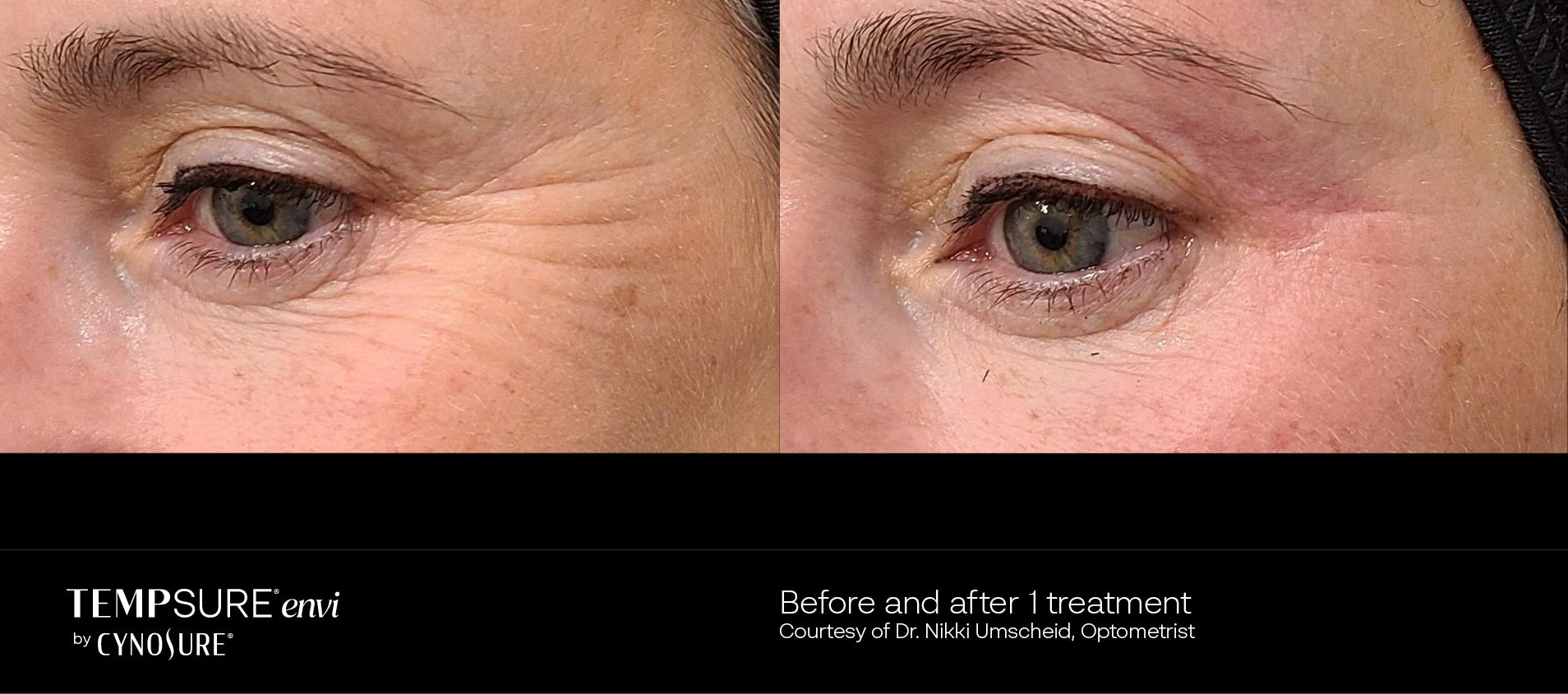 A before and after photo of a woman 's eyes.