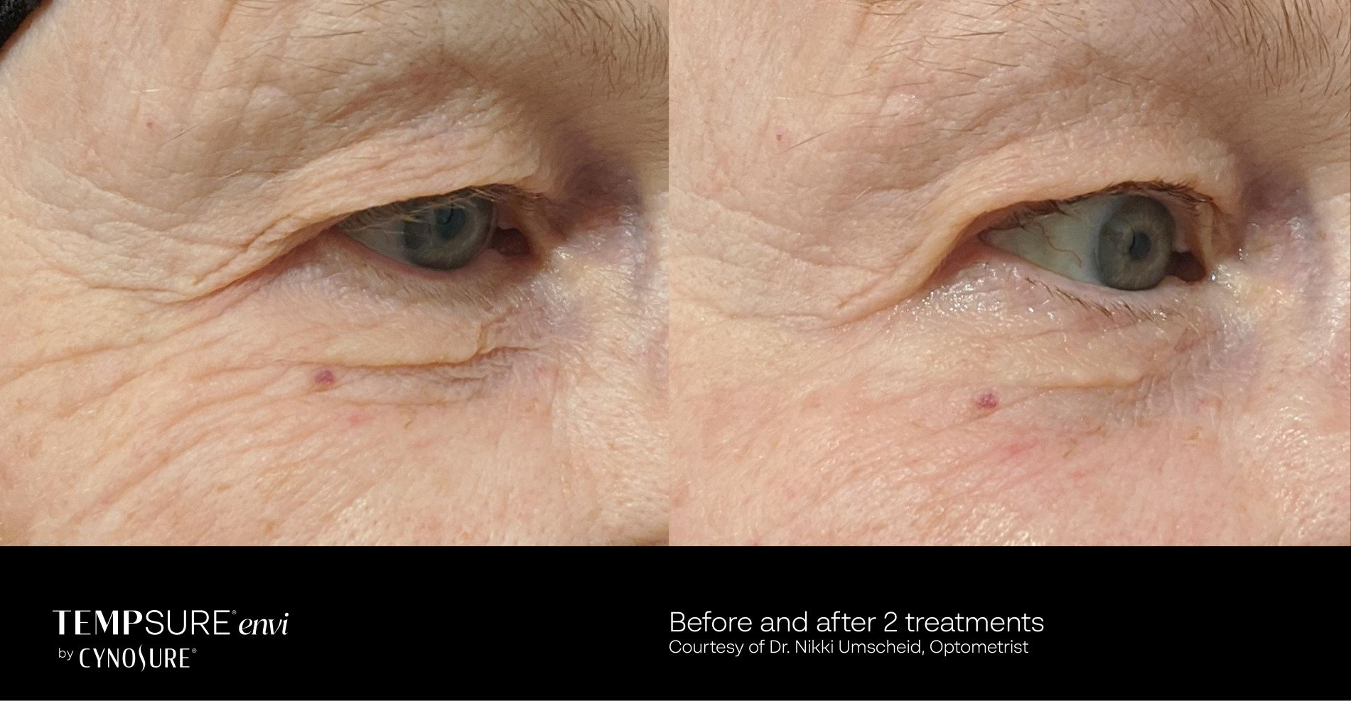 A before and after photo of an older woman 's eyes.
