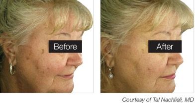 A before and after picture of a woman 's face