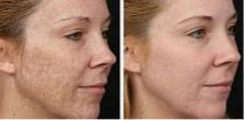 A before and after picture of a woman 's face.