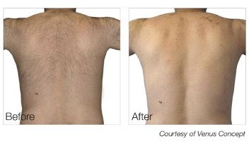 A before and after picture of a man 's back
